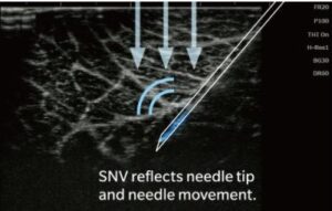 Sonimage HS2 ultrasound features blue needle technology